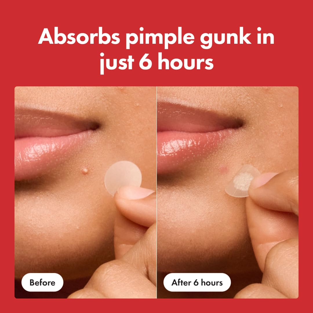 🔥 38% OFF FOR 5 DAYS ONLY! 🔥 | High-efficiency acne patches